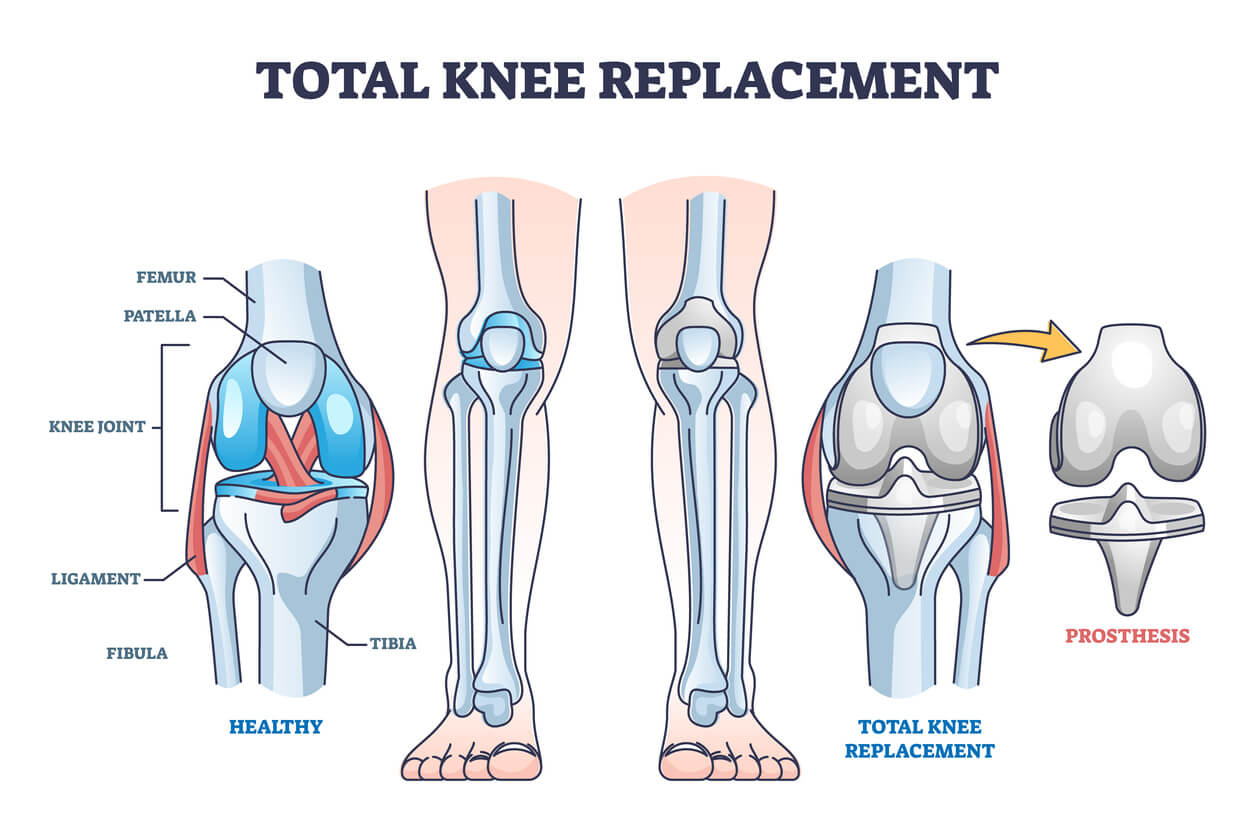 total knee replacement